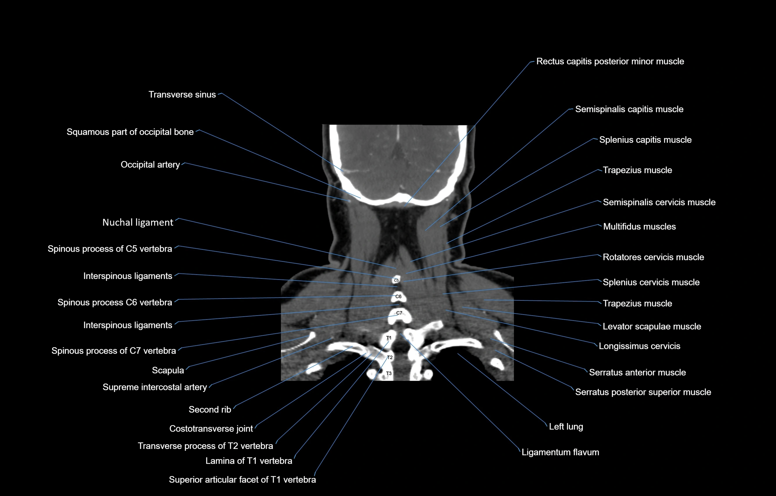 CT Neck coronal  cross sectional anatomy labelled 3D  radiology  image-00054.webp